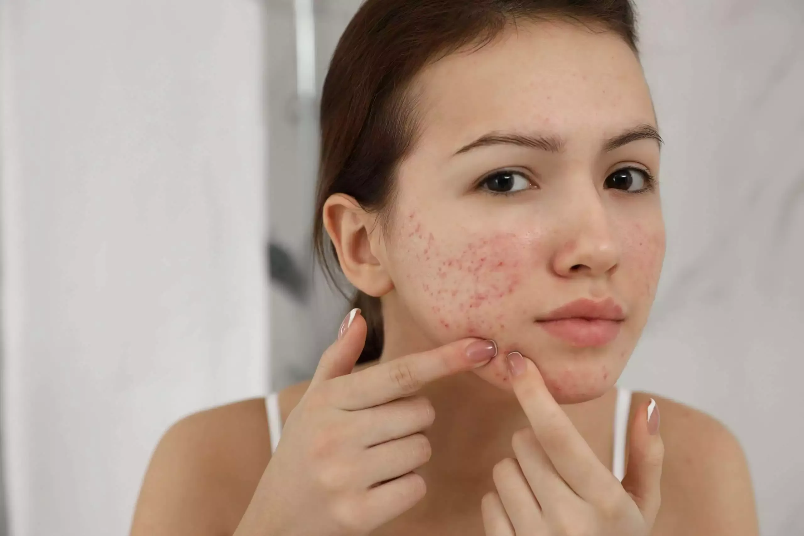 How to Get Rid of Red Spots on Face? 6 Proven Methods 7 acne