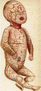 10 Weird Diseases Discovered in the World! 14 weird disease