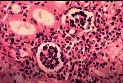 10 Weird Diseases Discovered in the World! 15 weird disease