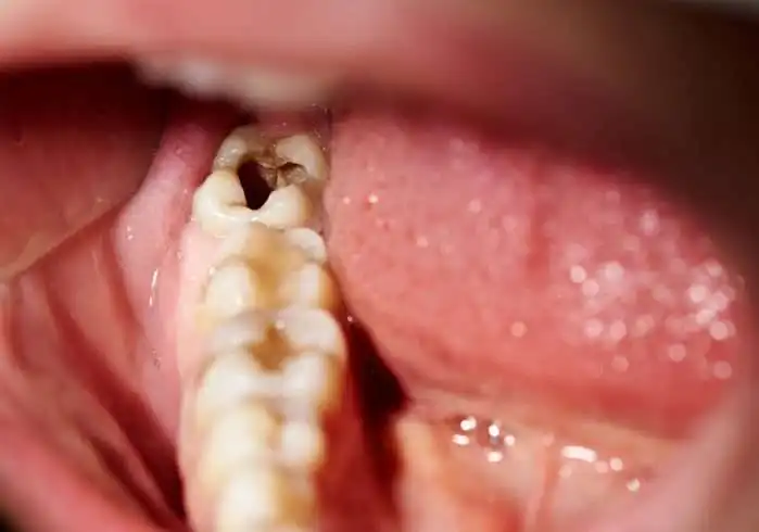 What Does a Cavity Look Like? 5 Best Treatment Options 11 What Does a Cavity Look Like? 5 Best Treatment Options 4