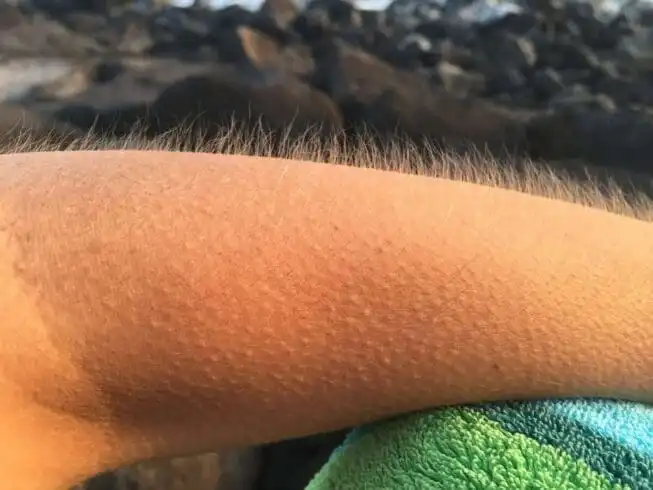 25 Fun Facts about the Human Body 12 Goosebumps