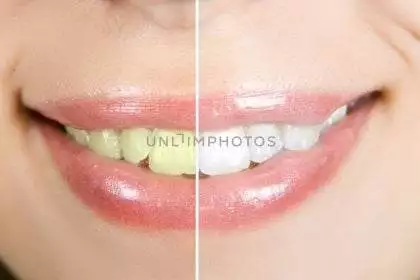 Baking Soda Teeth Whitening Hack | Excellent Facts About It !
